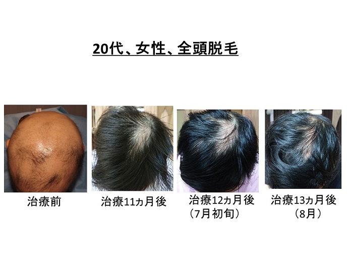円形脱毛症　病院